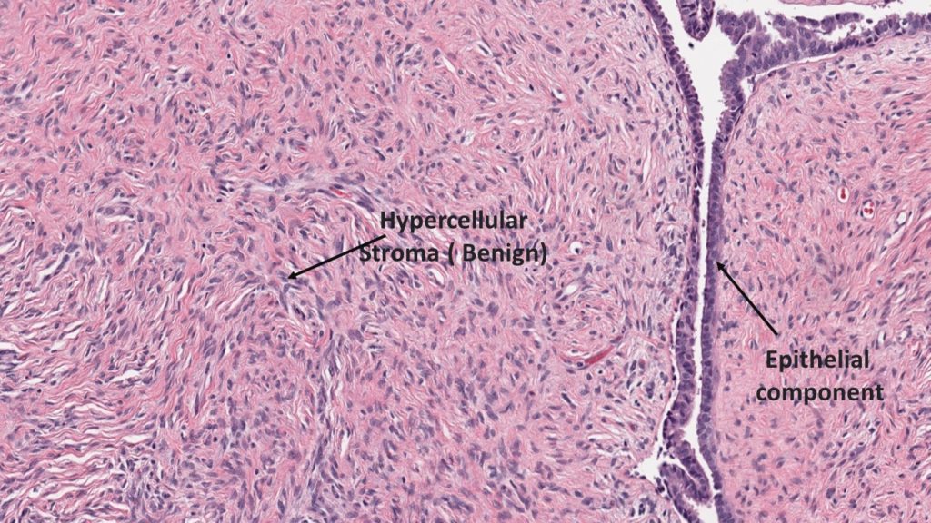 phyllodes tumor growth rate
