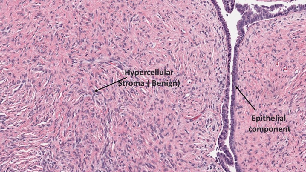 benign tumor histology