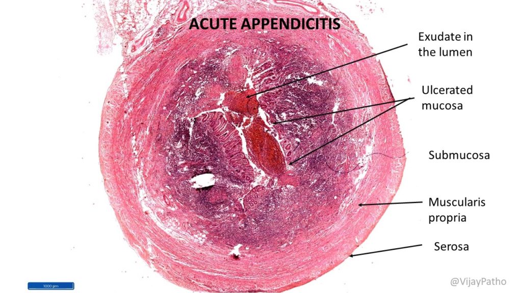 appendicitis histology