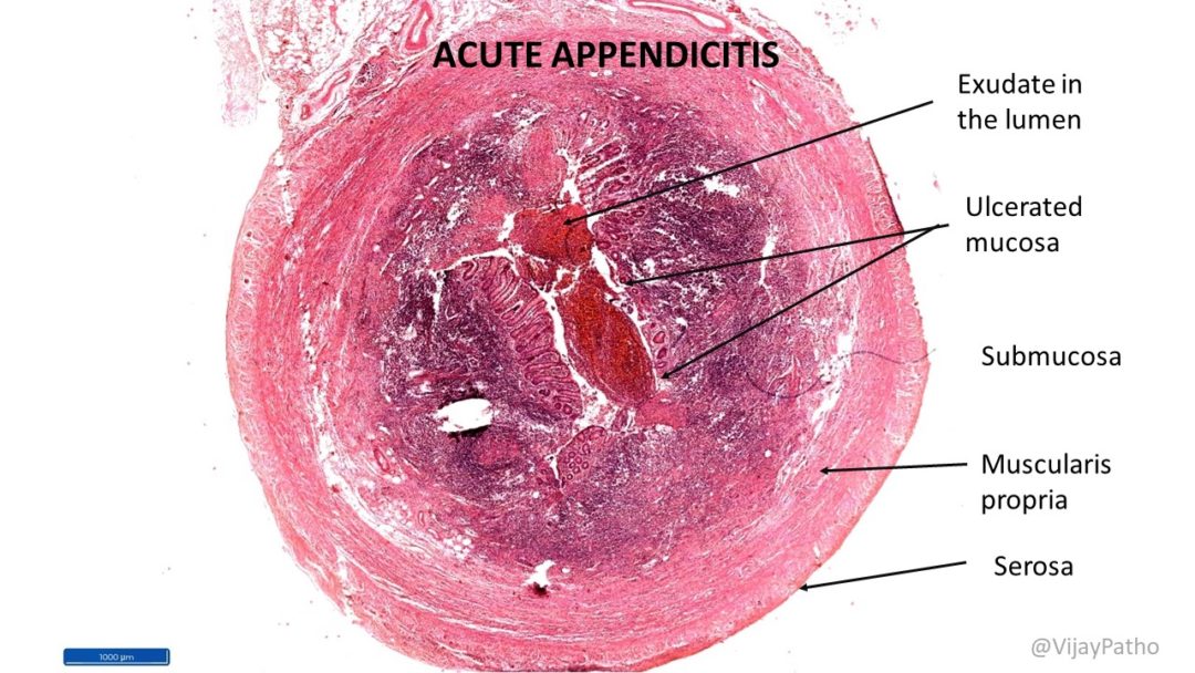 ACUTE APPENDICITIS - Pathology Made Simple