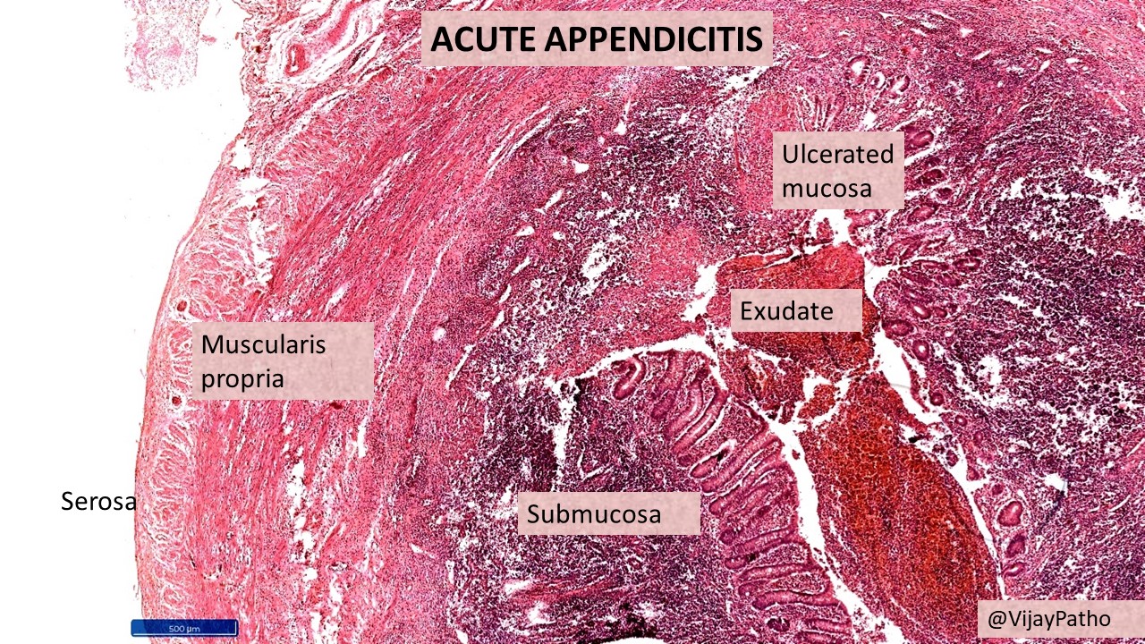 What Is Acute Appendicitis With Localized Peritonitis