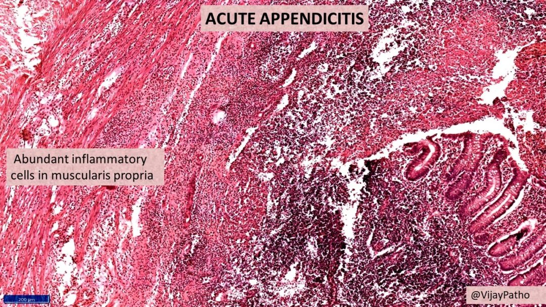 ACUTE APPENDICITIS - Pathology Made Simple