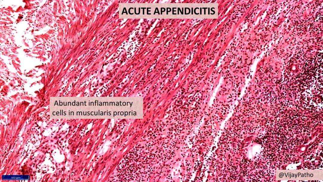 acute-appendicitis-pathology-made-simple