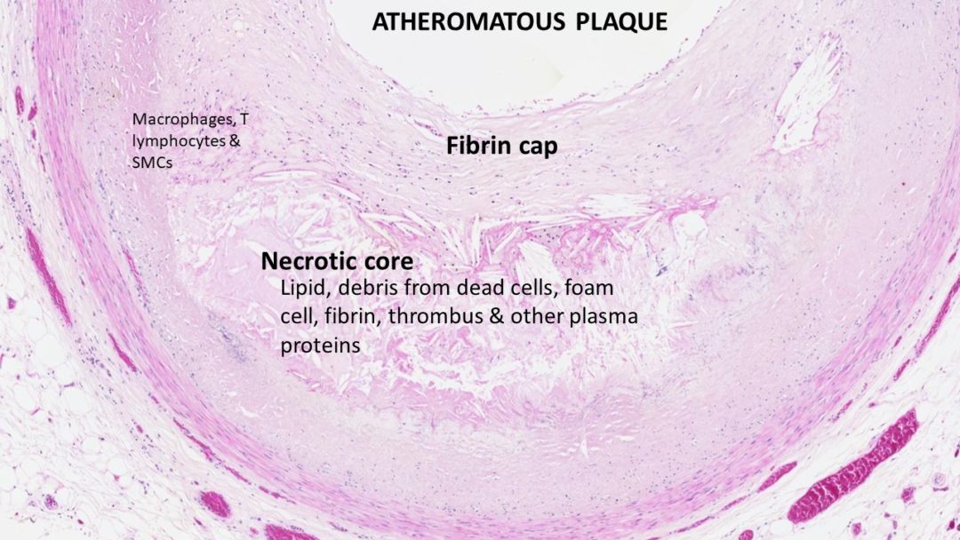 Pathology of Atherosclerosis Pathology Made Simple