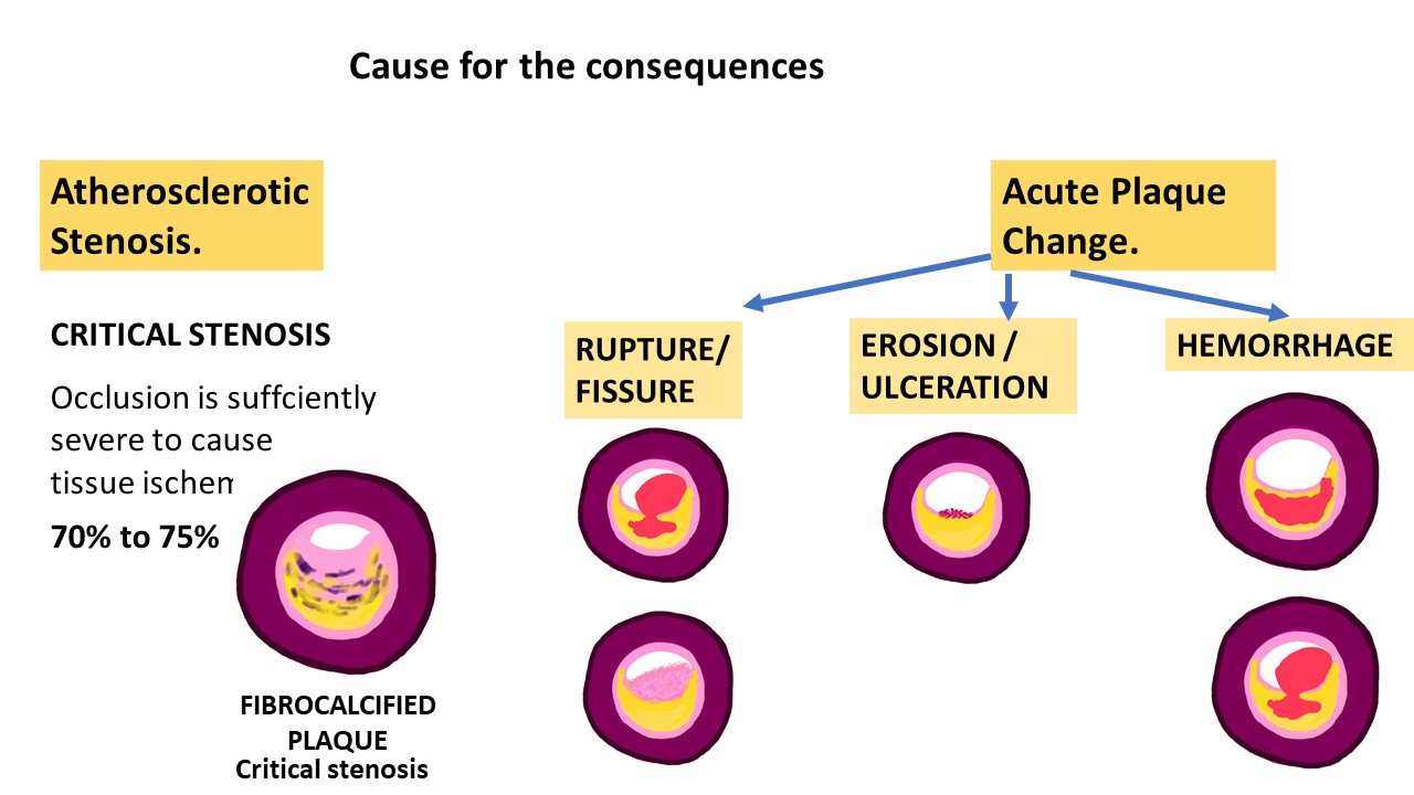 Pathology Of Atherosclerosis Pathology Made Simple