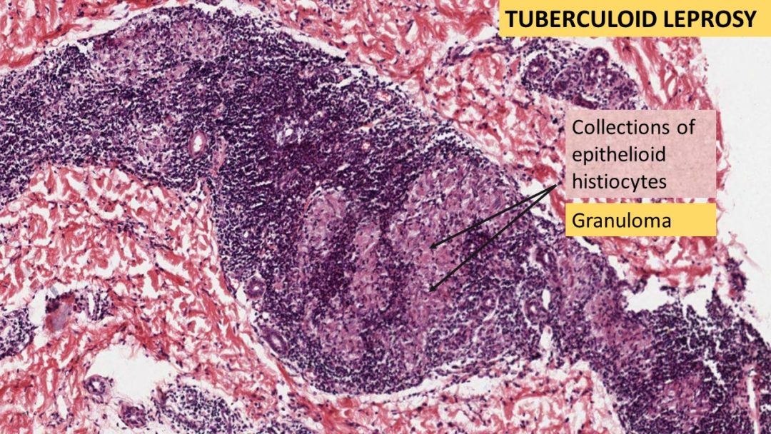 LEPROSY Tuberculoid Lepromatous Pathology Made Simple