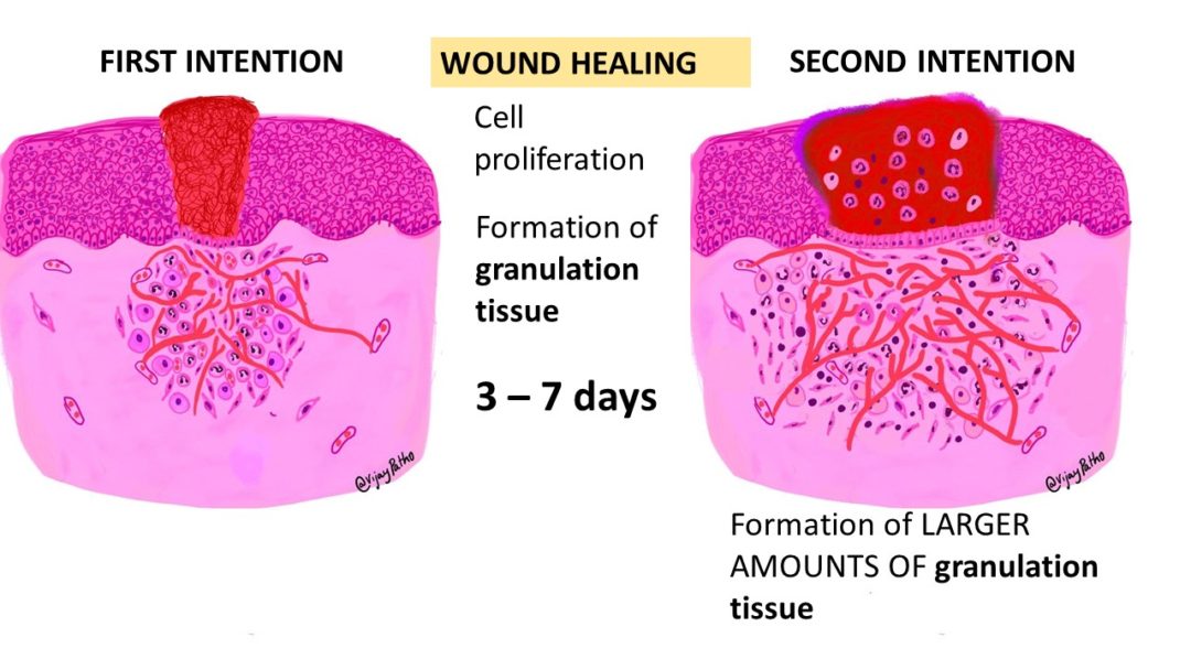 TISSUE REPAIR: Wound Healing | Pathology Made Simple