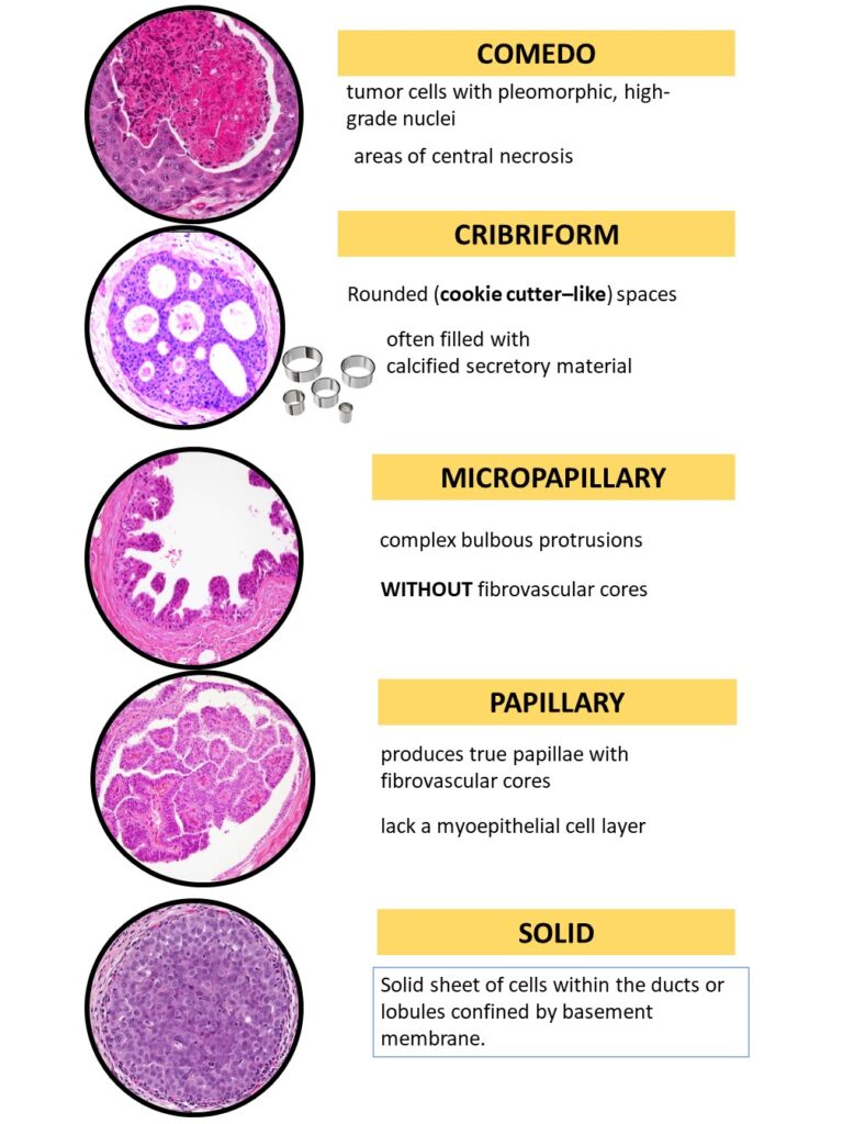 What Is High Risk Dcis