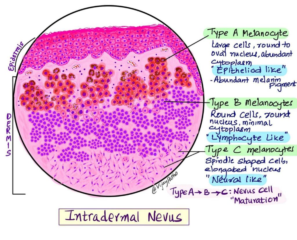 Benign Nevus Histology Intramucosal Melanocytic Nevi CCIDE