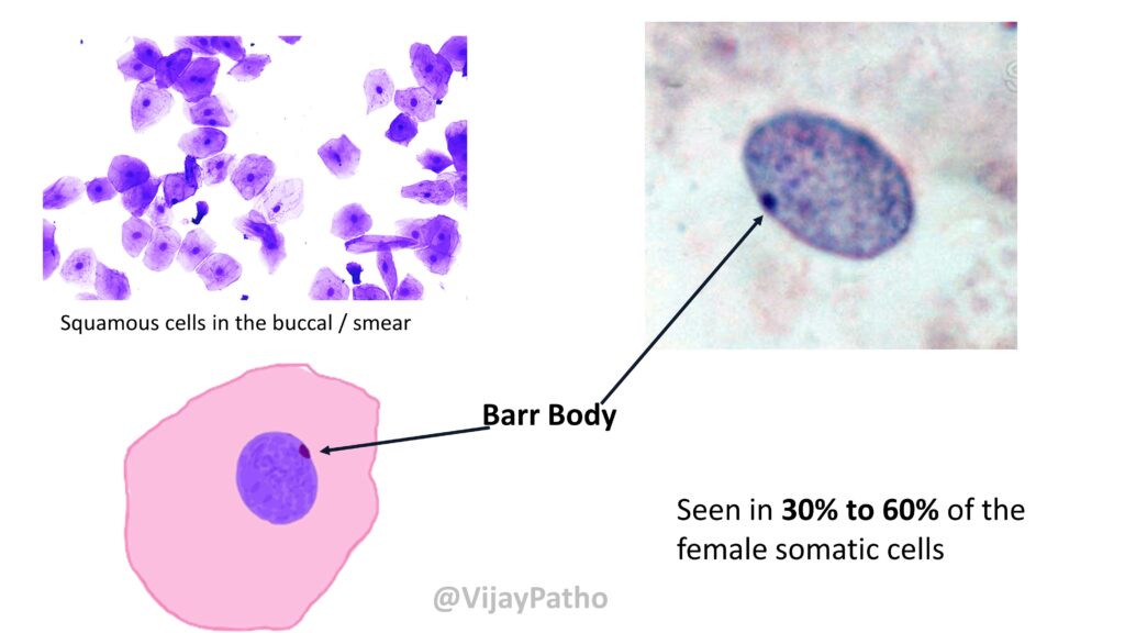 Barr Body X Chromatin Sex Chromatin And Davidson Body Pathology Made Simple 0706