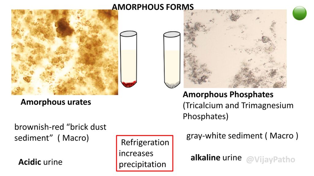ammonium biurate crystals in urine
