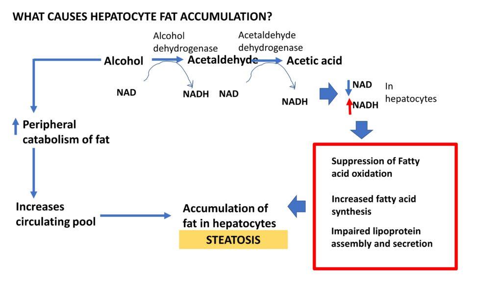 Alcoholic Liver Disease Types Pathogenesis Pathology Made Simple