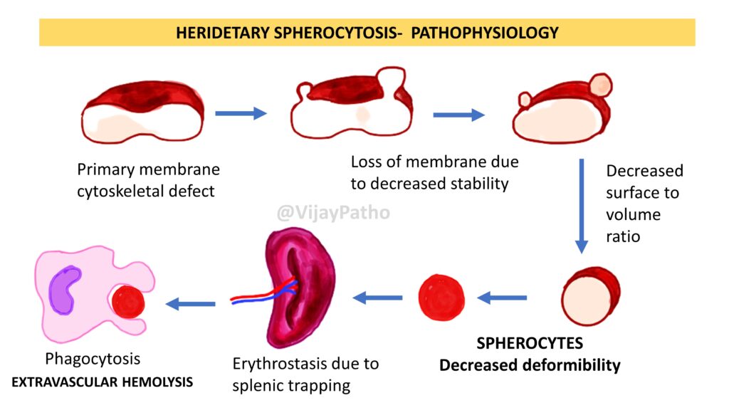 pathology-of-hereditary-spherocytosis-pathology-made-simple