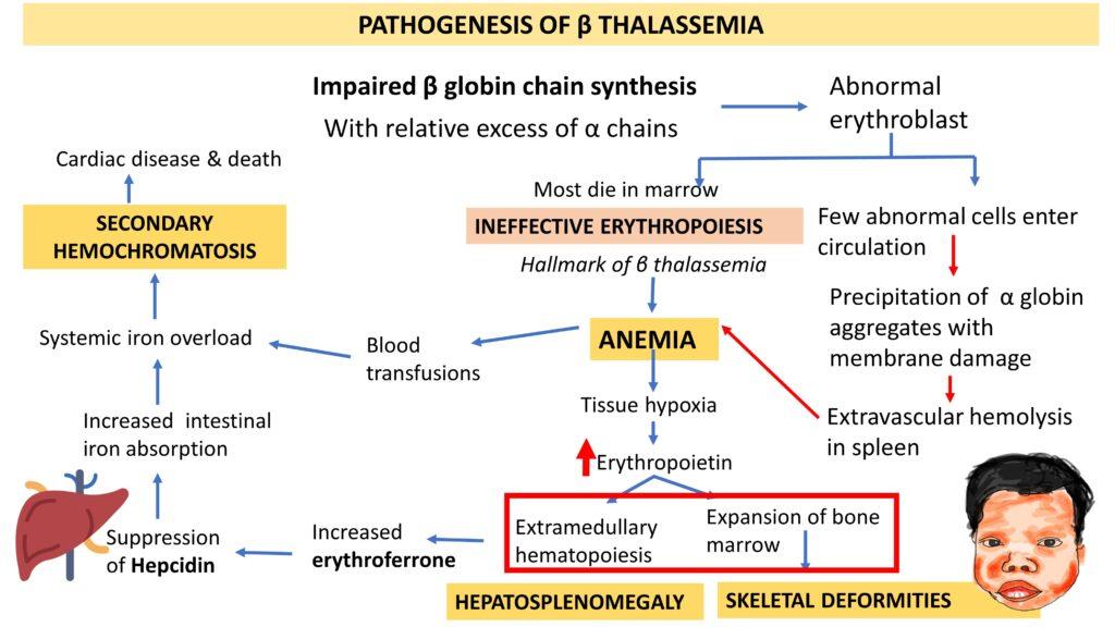 Pathology Of β Thalassemia Pathology Made Simple