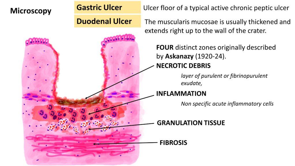 stomach-ulcer-treatment-med-health