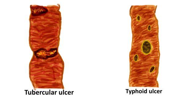 Tubercular Vs Typhoid Ulcer - Pathology Made Simple