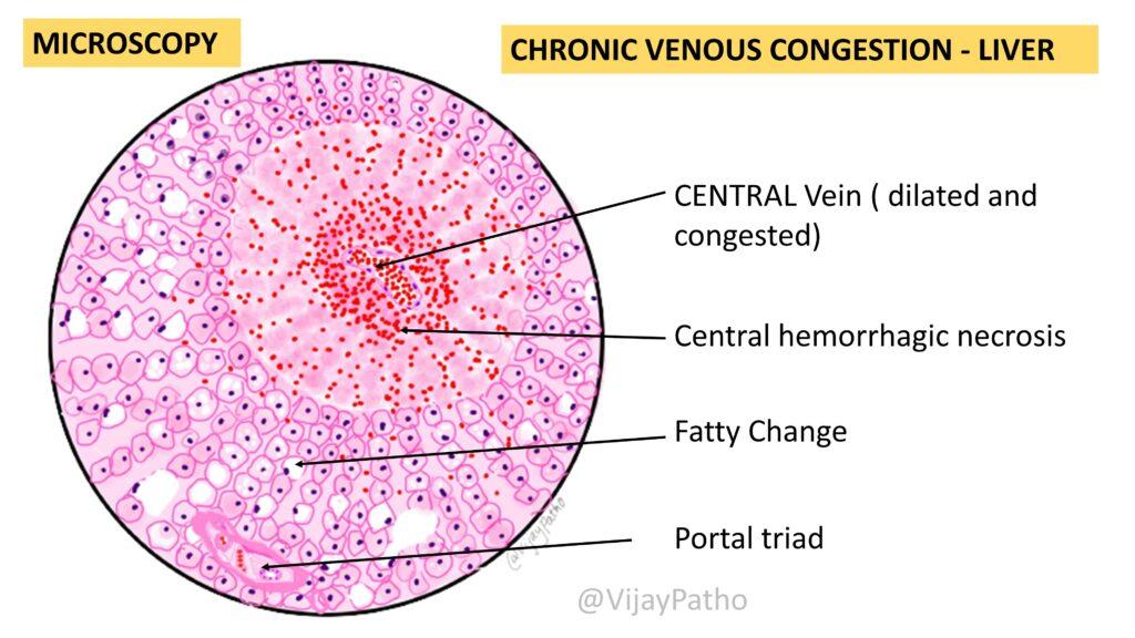 Chronic Venous Congestion Liver Pathology Made Simple