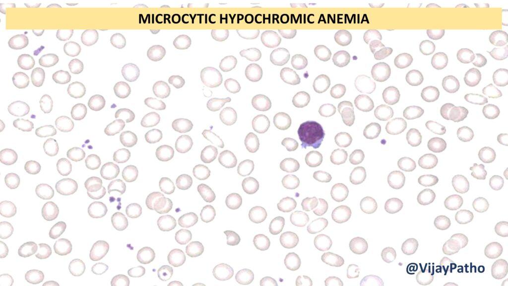 Microcytic Hypochromic Anemia Causes And Diagnosis Pathology Made Simple
