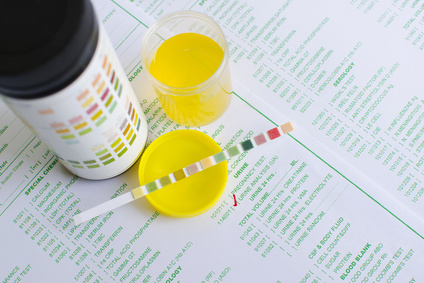 Urine Analysis: Common Questions