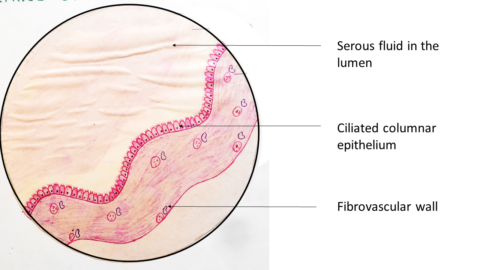 Serous Cystadenoma – Ovary