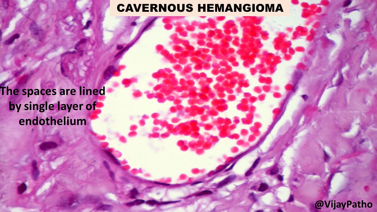 Cavernous Hemangioma Pathology Made Simple   Slide4 1 