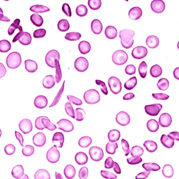 Sickle cell Anemia
