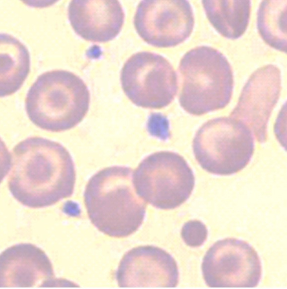 Hemoglobinopathies: Thalassemia