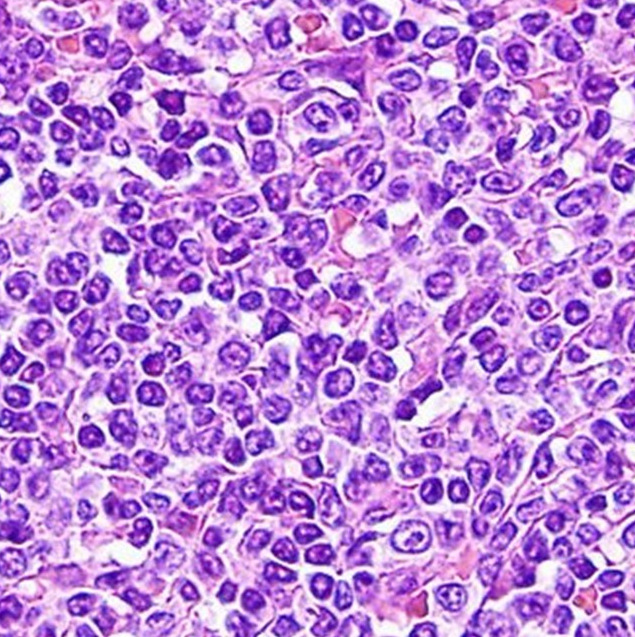 B Cell Lymphoma Archives Pathology Made Simple