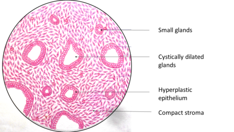 Benign Prostatic Hyperplasia (BPH) | Pathology Made Simple