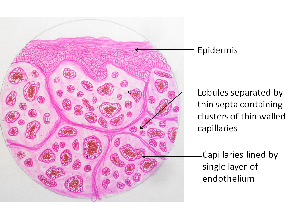 Capillary Hemangioma - Pathology Made Simple