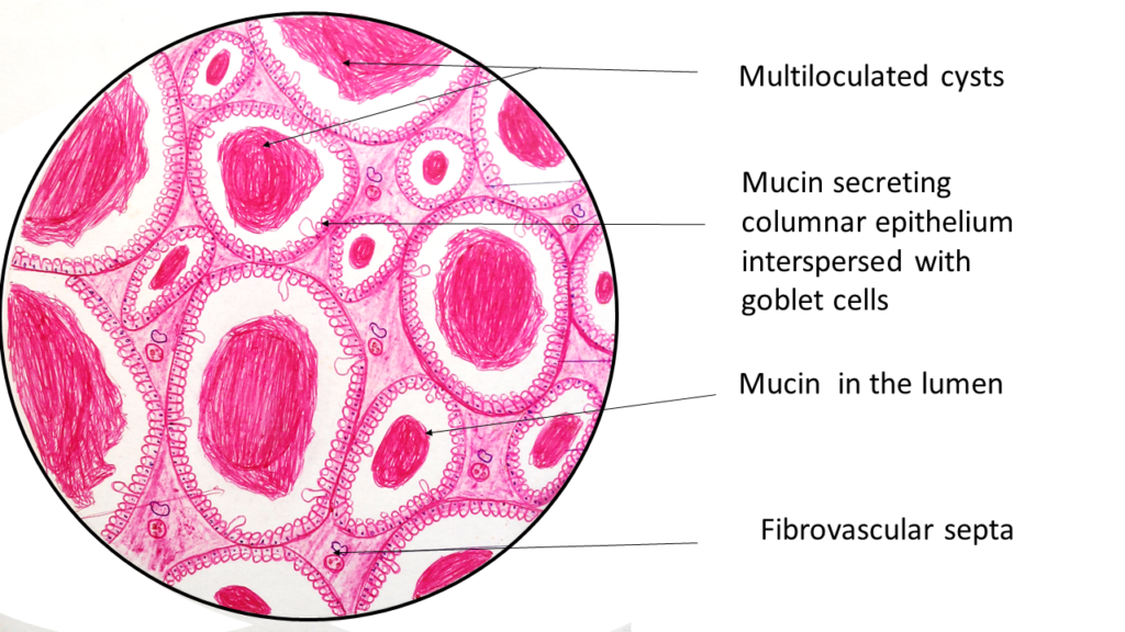 mucinous cystadenoma ovary