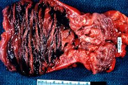 Napkin ring constriction of distal colon carcinoma