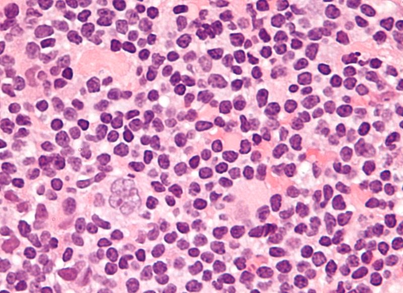 800px-popcorn_cell_in_nodular_lymphocyte_predominant_hodgkin_lymphoma_-_very_high_mag_cropped