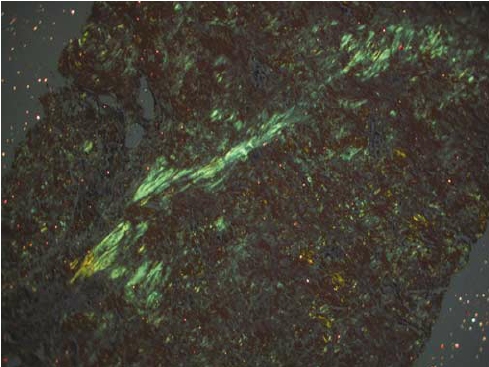 figure-5-apple-green-birefringence-of-the-congo-red-positive-amyloid-material-of-the