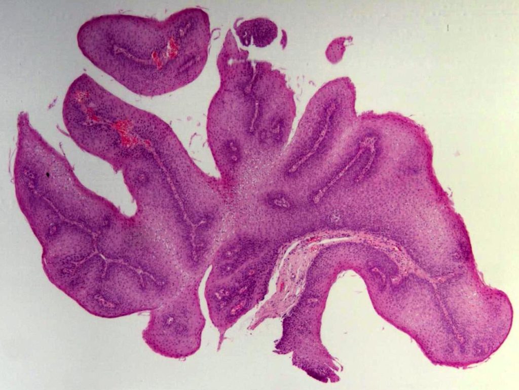 squamous_papilloma_of_the_esophagus_he_1