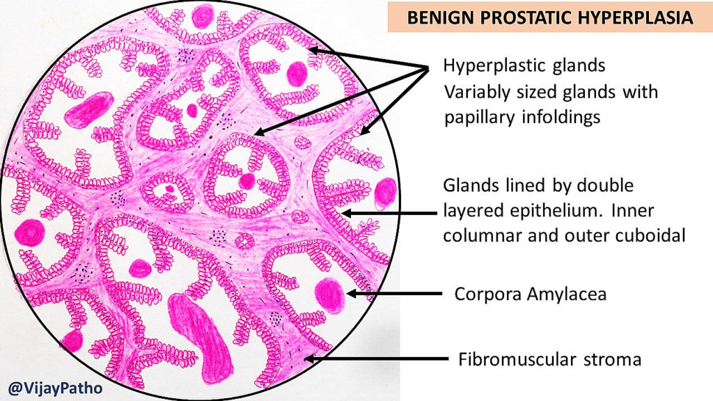 Benign Prostatic Hypertrophy Histology