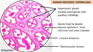 Benign Prostatic Hyperplasia (BPH) | Pathology Made Simple