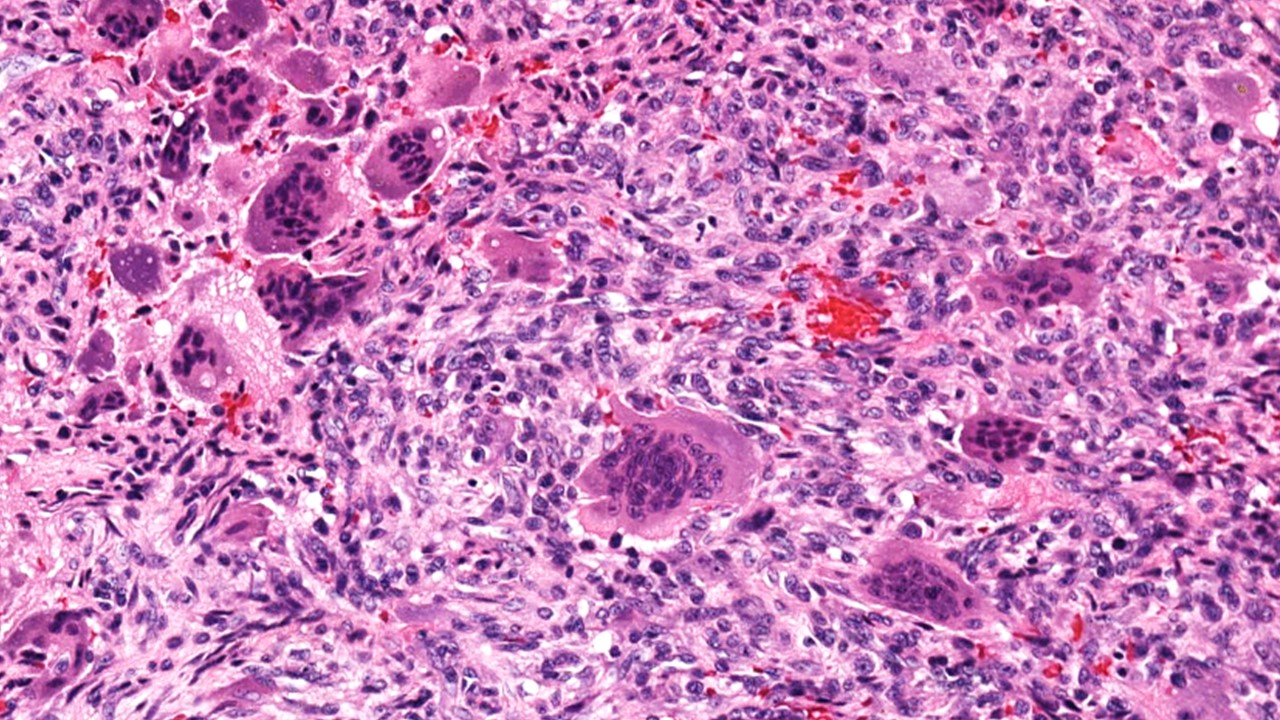 Giant Cell Tumor Of Bone Histology