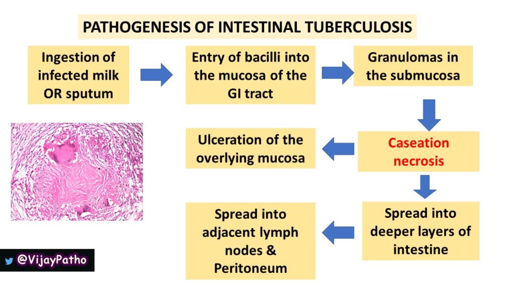 Intestinal Tuberculosis Pathology Made Simple