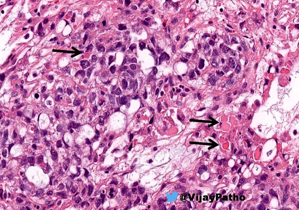 Hyaline Globules | Pathology Made Simple