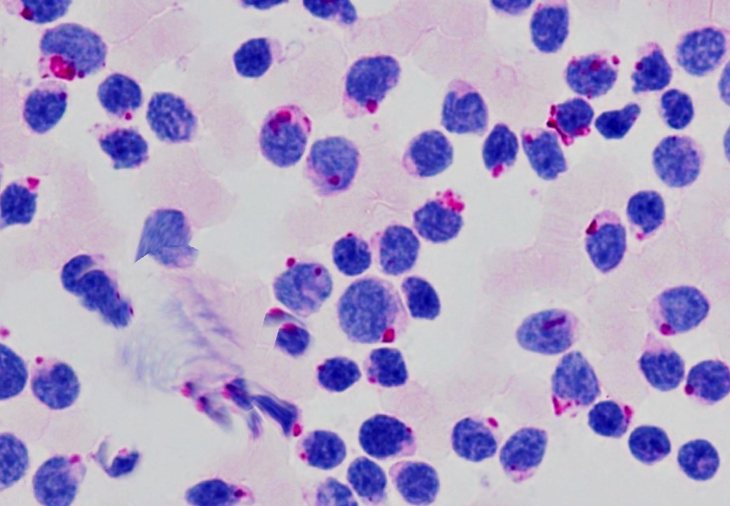 CYTOCHEMICAL STAINS IN HEMATOLOGICAL NEOPLASMS.