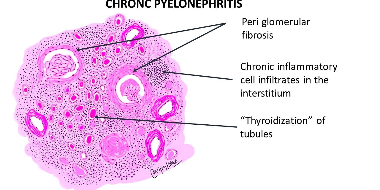 CHRONIC PYELONEPHRITIS  Pathology Made Simple