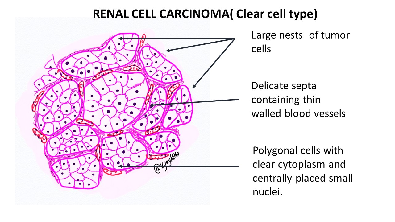 presentation of renal clear cell carcinoma