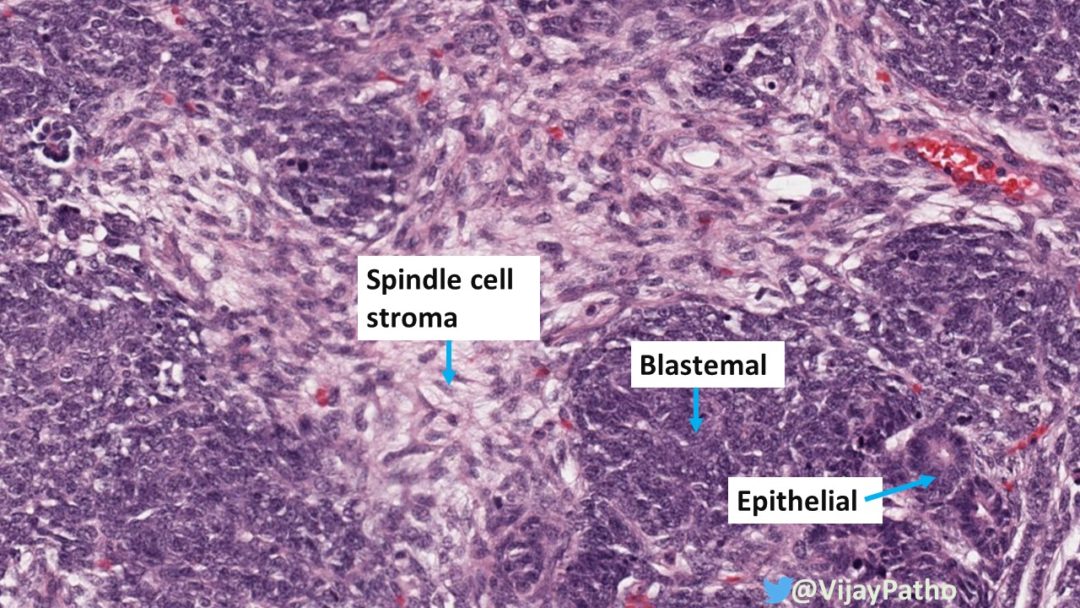 WILMS TUMOR( NEPHROBLASTOMA) - Pathology Made Simple