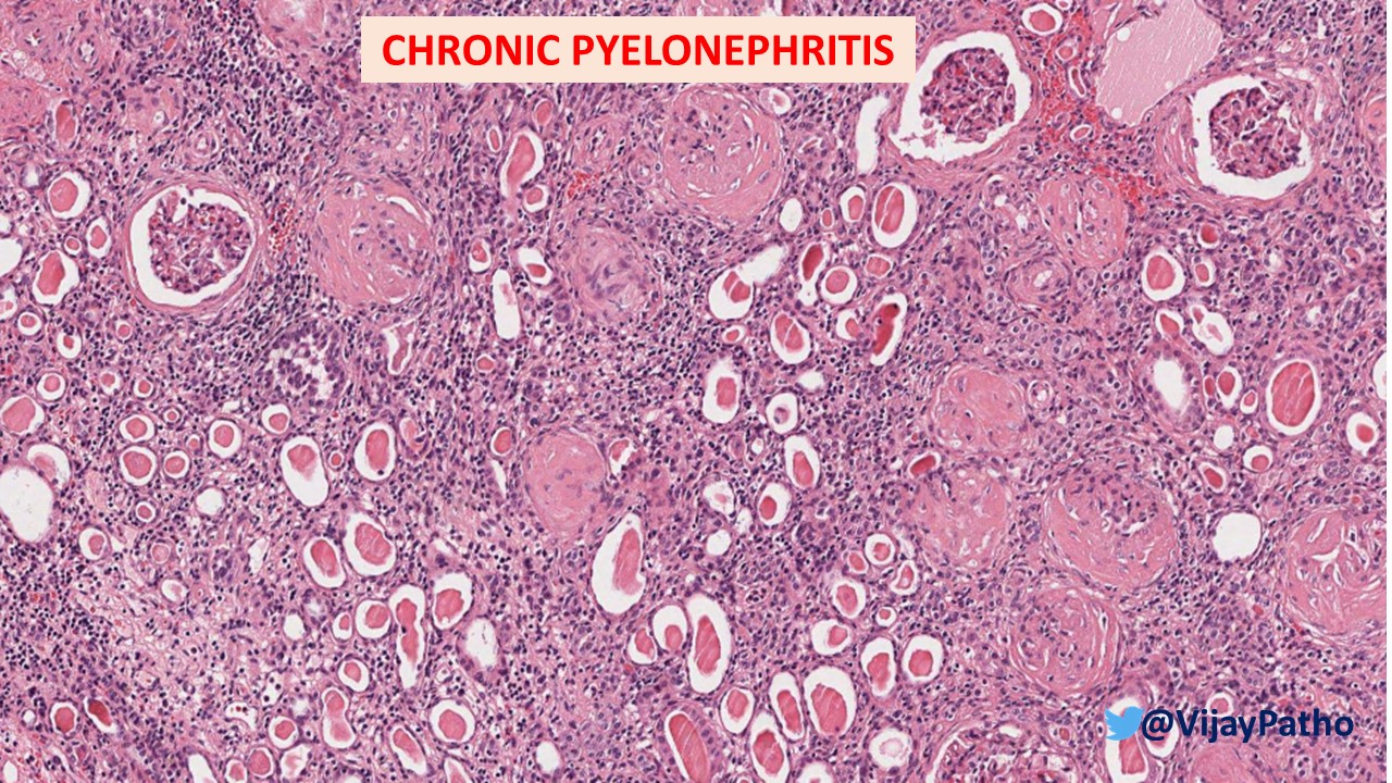 Хронический пиелонефрит микроскопическая картина