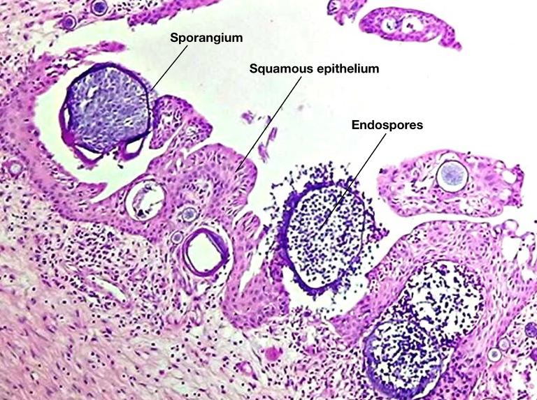 Rhinosporidiosis