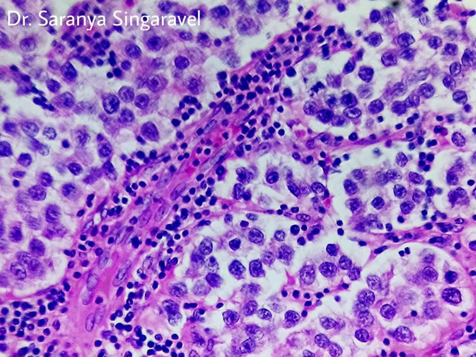 SEMINOMA TESTIS Pathology Made Simple