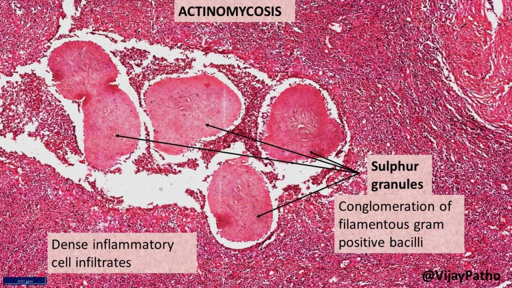 - Caused by Actinomyces israelii. 
Opportunistic, chronic, and granulomatous infection.
Most common characteristic: sulfur granules in purulent exudate


 oral pathology nbde inbde ndeb afk oral medicine dentistry notes video mental remember grades how to pass resources how to prepare