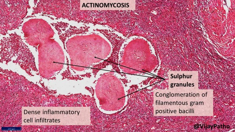 ACTINOMYCOSIS | Pathology Made Simple