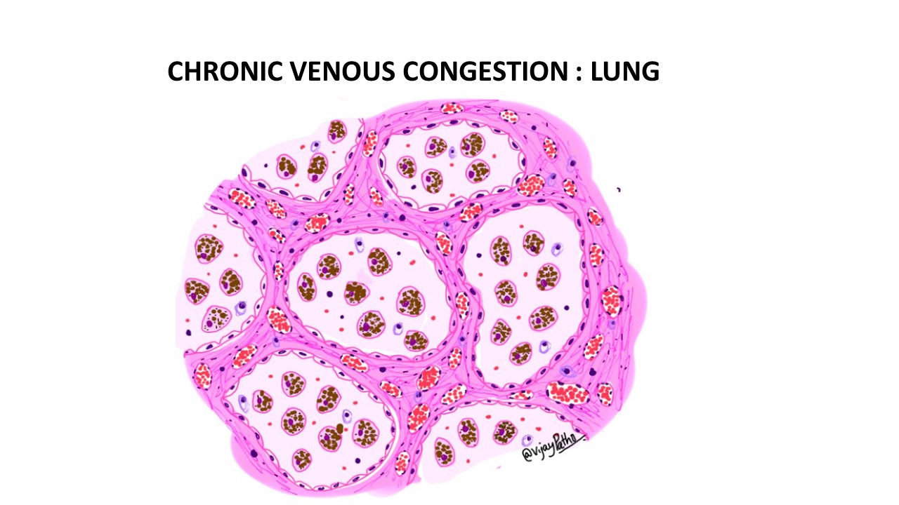 cp8-1-benign-lung-pathology-notes-1718-benign-lung-pathology